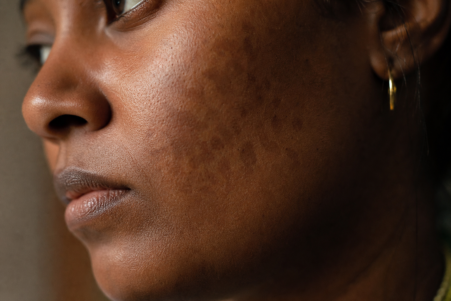 After the flare clears, the mark stays: why rosacea resolution looks different on darker skin