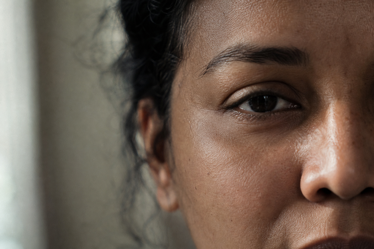 Rosacea and Seborrheic Dermatitis at the Same Time: When Treating One Makes the Other Worse